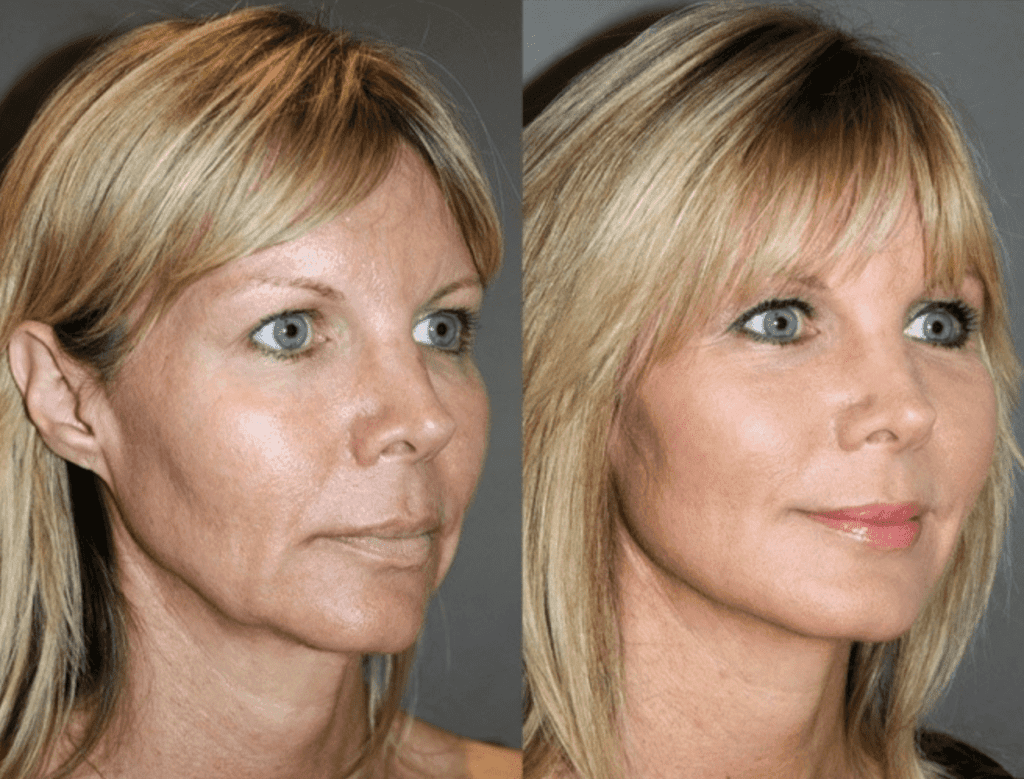 sublime-face-skin-tightening-at-Youthful-Solutions
