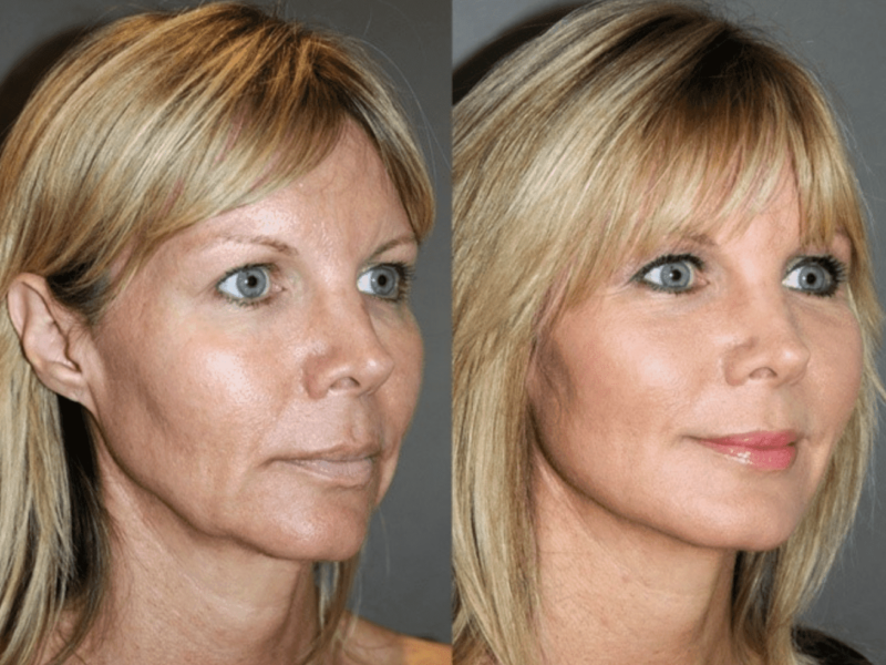 sublime-face-skin-tightening-at-Youthful-Solutions