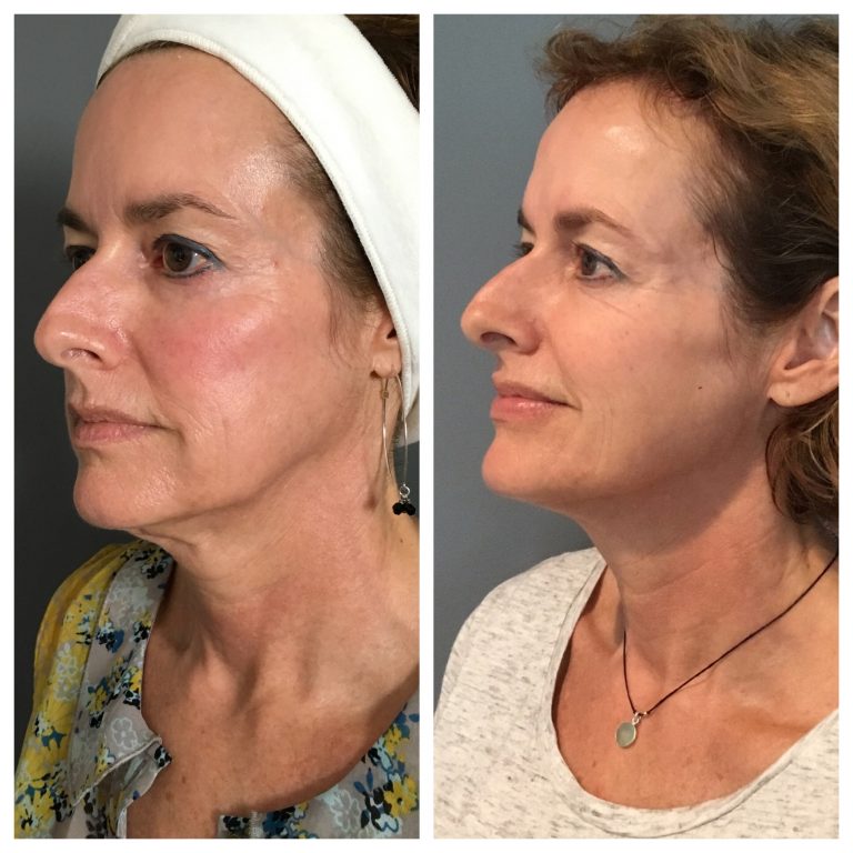 Skin-Tightening-Profound-RF-delle-chiaie-768x768-836292315