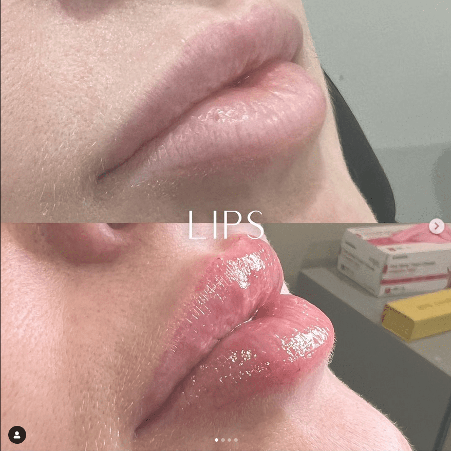 Lips 3