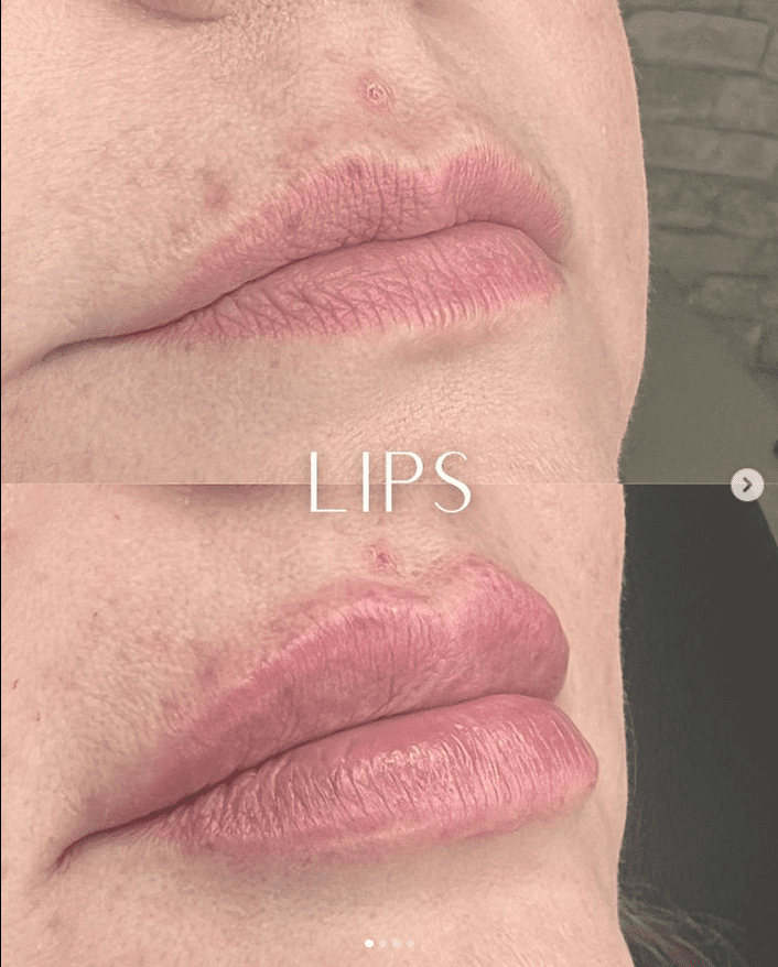 Lips