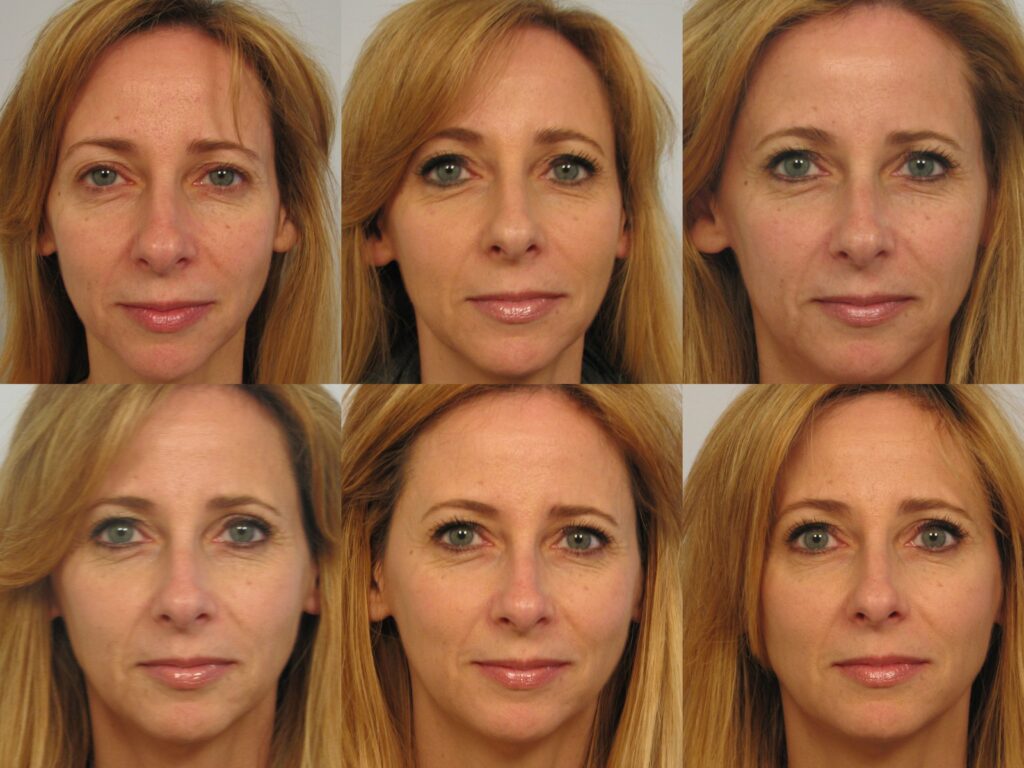 sculptra before and after
