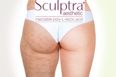 sculptra butt