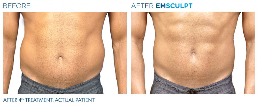 Emsculpt-before-and-after-man