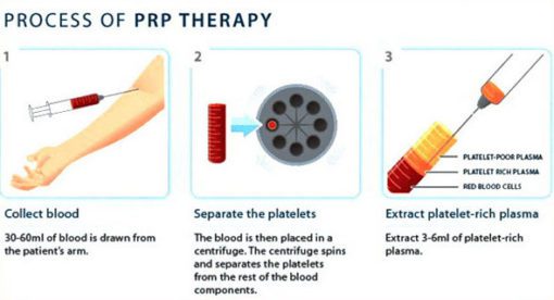 PRF 1