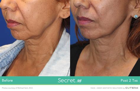 secret5